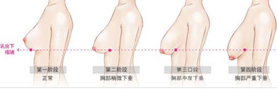 40多岁能做隆胸手术吗？20-40岁都适合哪种隆胸